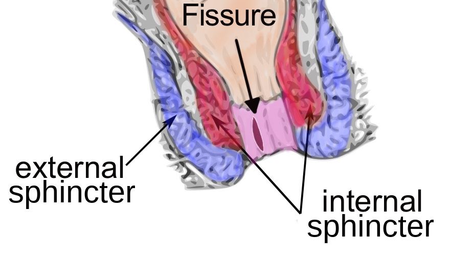What is an anal fissure?